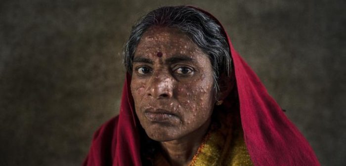 Lalita Devi, paciente con leishmaniasis dérmica post-kala azar que fue tratada en nuestra unidad en el Hospital Sadar en Hajipur, India.Sami Siva