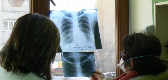Tratamiento de Médicos Sin Fronteras en Armenia  en 2013 contra la tuberculosis resistente a los medicamentos. ©Andrea Bussotti/MSF