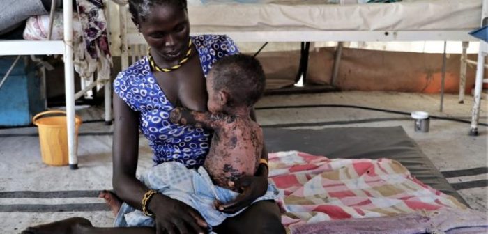 Wovo Logocho amamanta a su bebé con sarampión severo en la clínica de Médicos Sin Fronteras en la ciudad de Pibor, Sudán del Sur.MSF/Tetiana Gaviuk