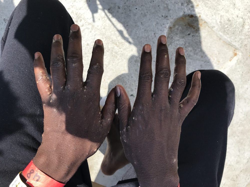 Imagen de archivo de 2018: Un hombre rescatado a bordo del Aquarius muestra los efectos de la sarna, una infestación de ácaros en la piel comúnmente vista en refugiados, solicitantes de asilo y migrantes que han estado retenidos en condiciones inhumanas en Libia © Lauren King/MSF.