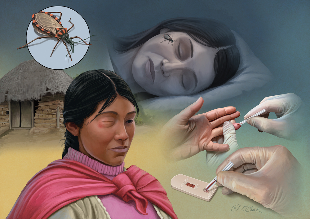 Ilustraciones de la Enfermedad de Chagas. 