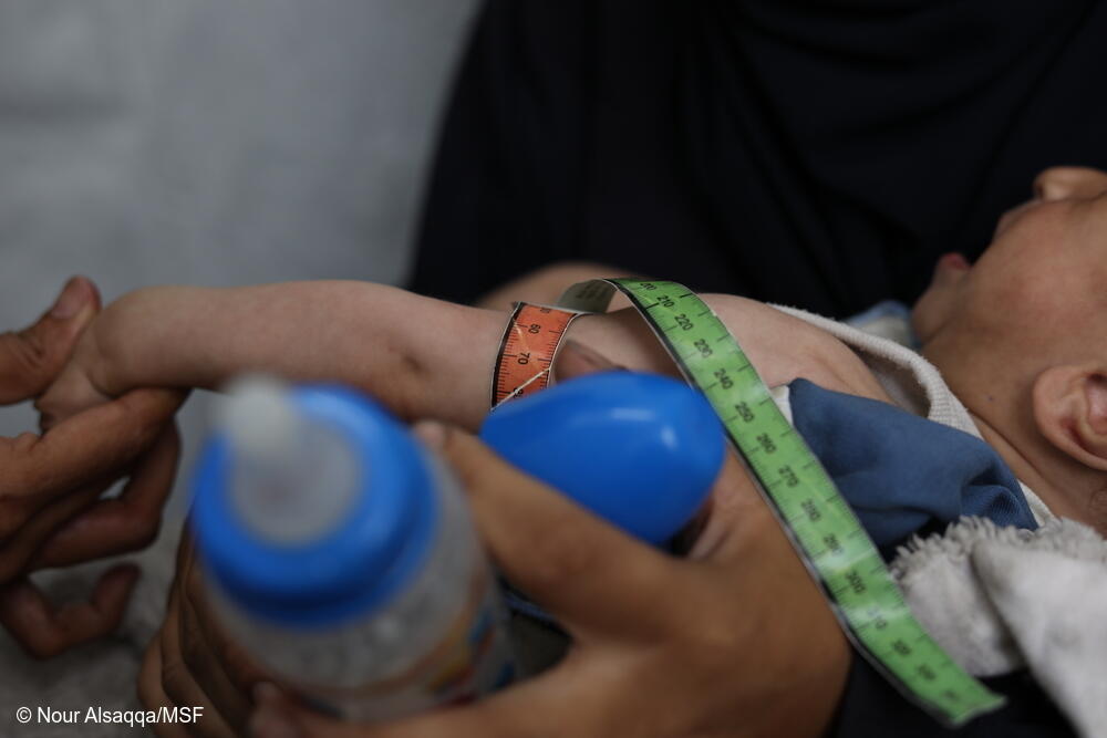 Un niño palestino que sufre desnutrición se somete a un chequeo médico en la clínica de Médicos Sin Fronteras (MSF) en la ciudad de Gaza.