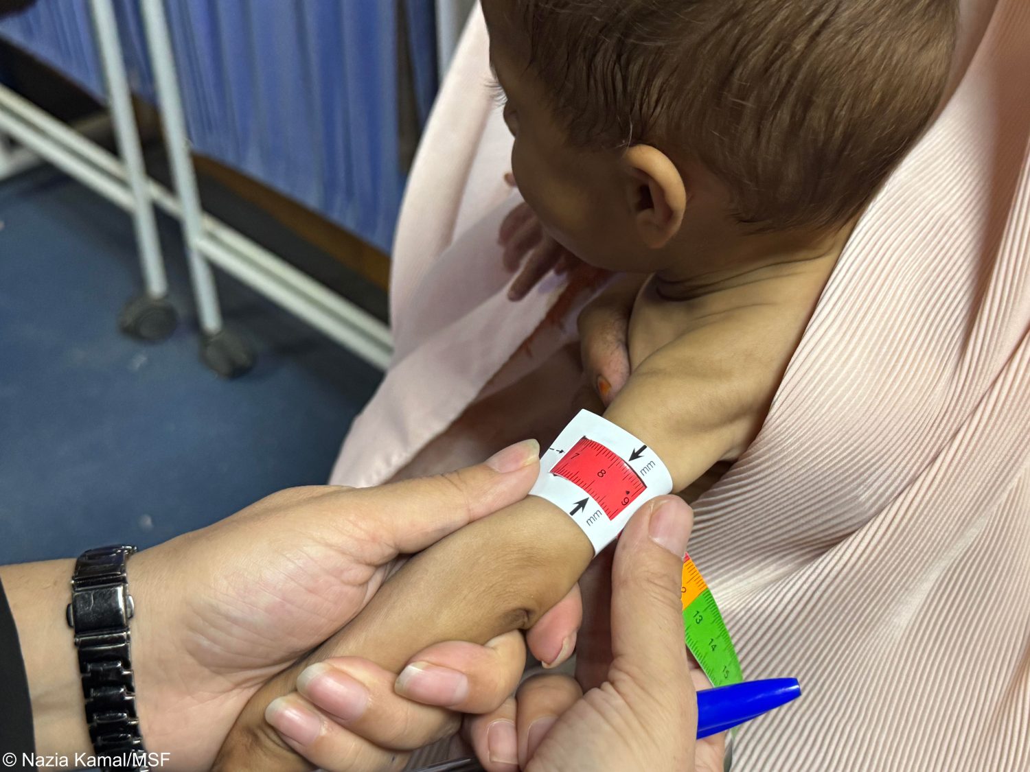 Niño con desnutrición